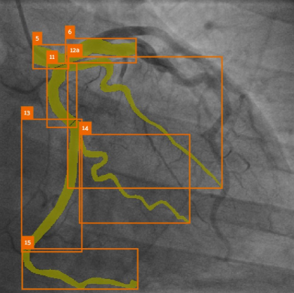 MPSeg coronary artery segmentation figure