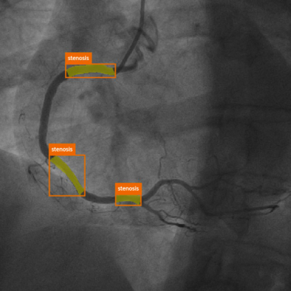 SASS stenosis segmentation figure
